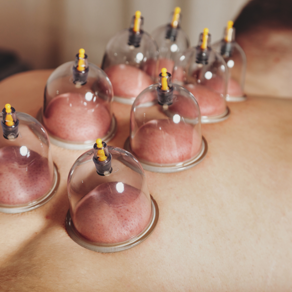 Wet Cupping